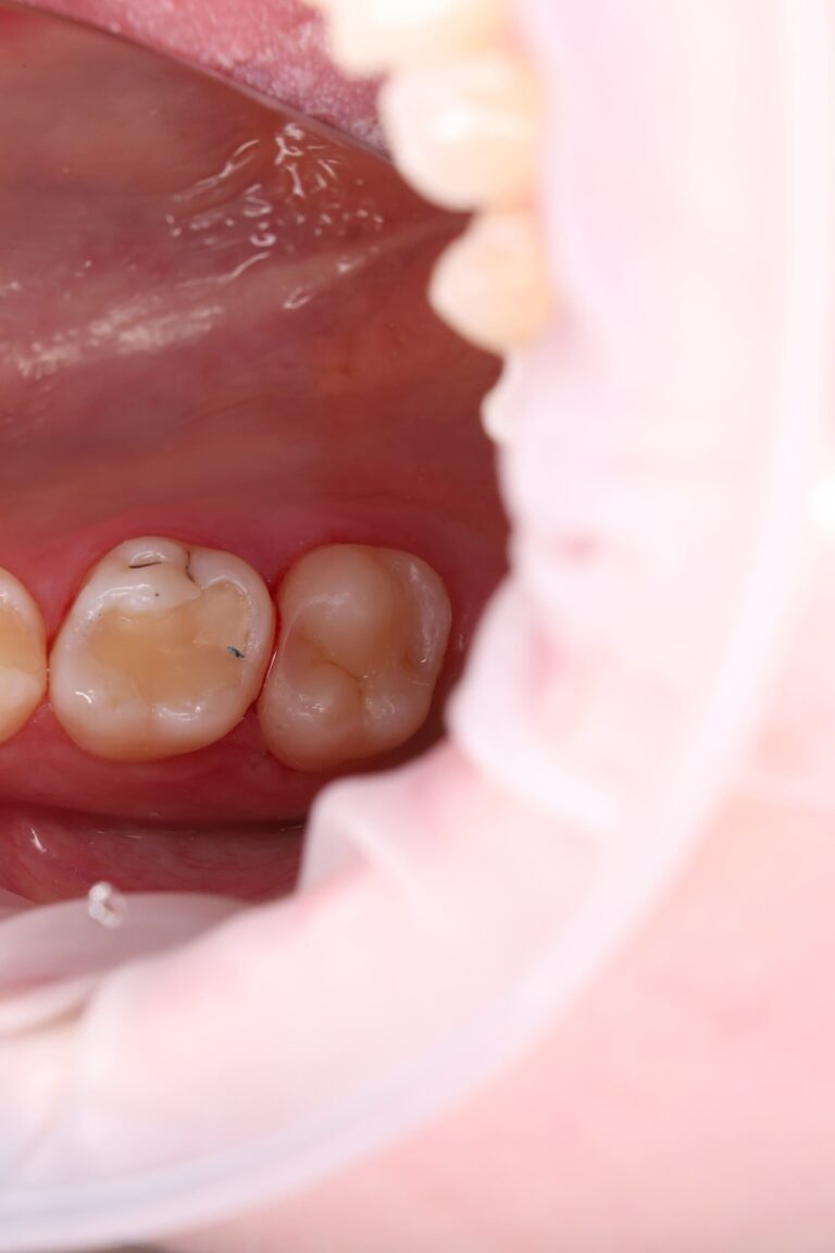 Treatment of interproximal caries and aesthetic restoration with composite material.