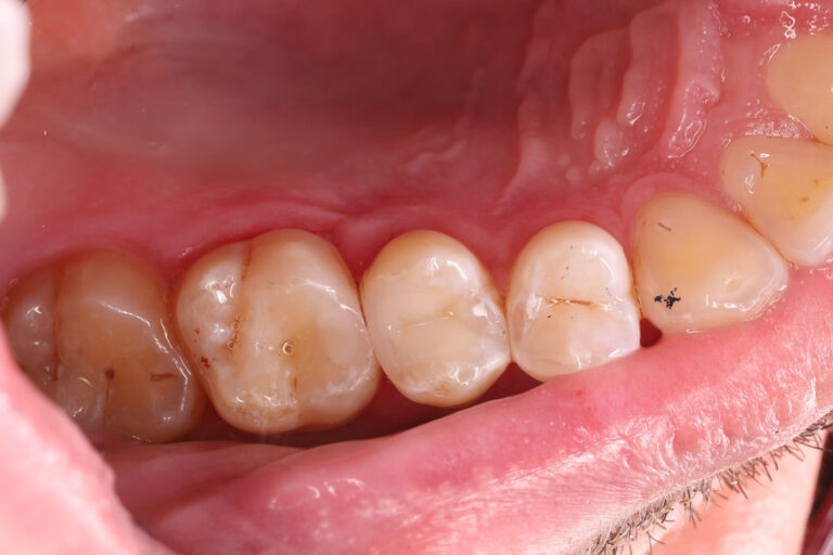 Microscope-assisted endodontic treatment and tooth restoration for subsequent prosthetic rehabilitation.