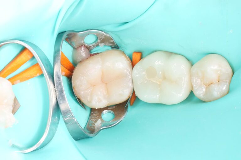 Removal of carious lesions and anatomical composite restoration of the tooth.
