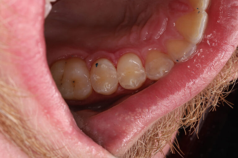 Removal of carious lesions and anatomical composite restoration of the tooth.