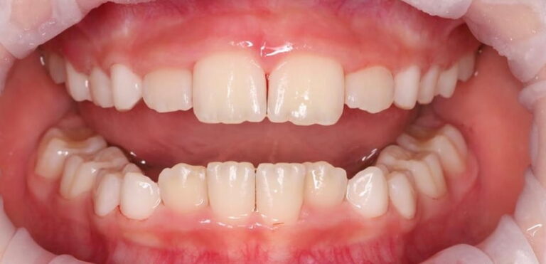 Professional oral hygiene for a child under 8 years of age.