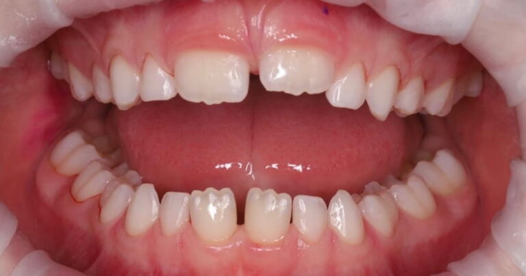 Professional oral hygiene for a child under 8 years of age.