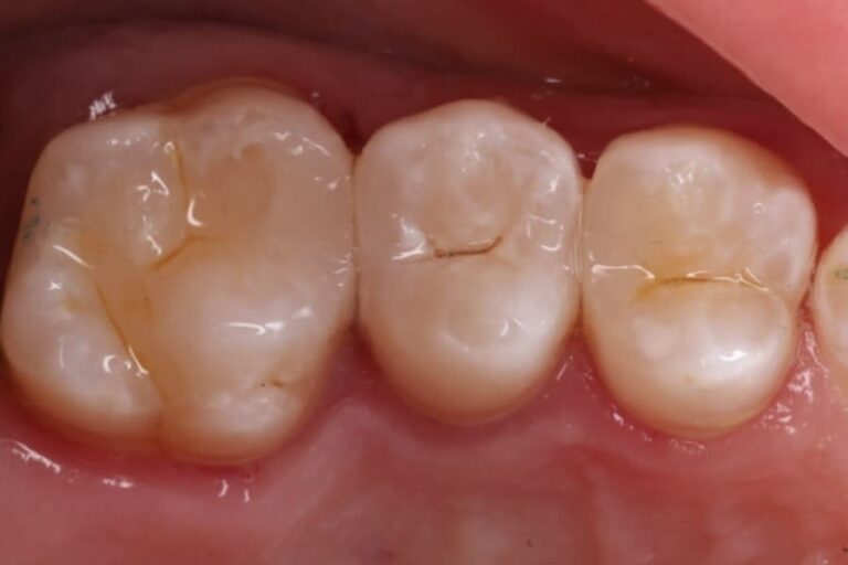 Aesthetic and functional restoration of posterior teeth