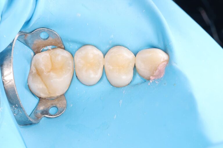 Aesthetic dental restoration with anatomical reconstruction.