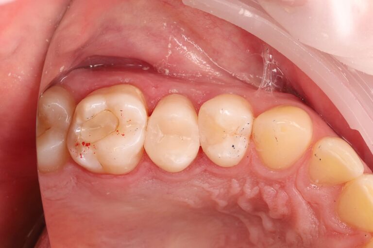 Aesthetic and functional composite restoration of tooth 25.