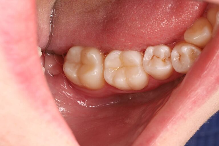 Treatment of a secondary carious lesion.