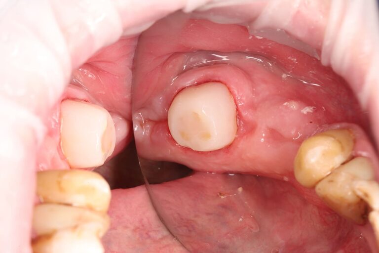 Caries treatment and composite core restoration of the tooth for subsequent prosthetic rehabilitation.