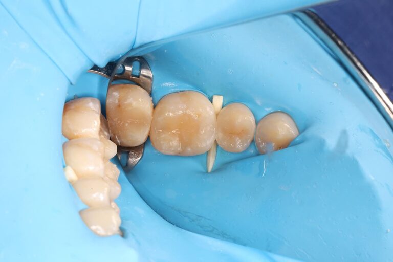 Treatment of interproximal caries after completion of orthodontic treatment.