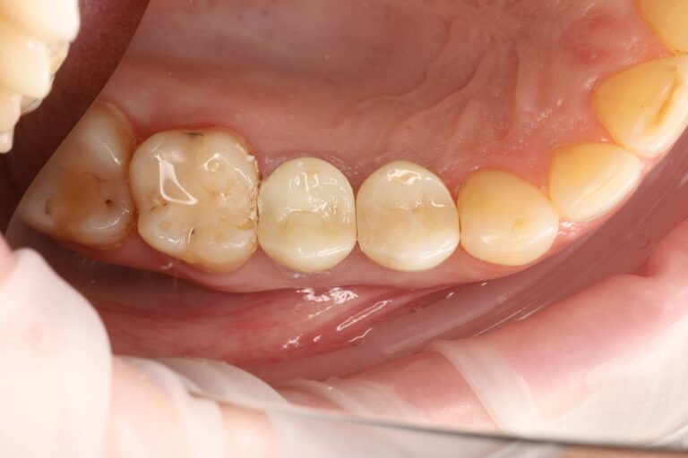 Restoration of Dental Aesthetics and Function Using an Implant and a Zirconia Crown